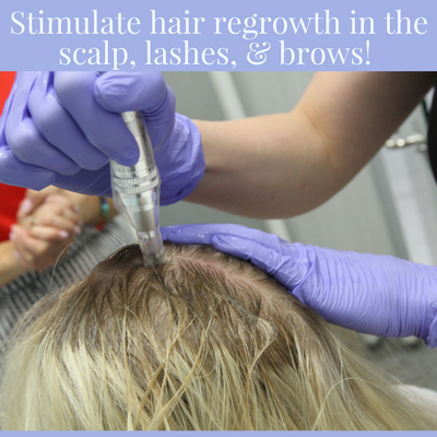 Hair Regrowth - it can be done!